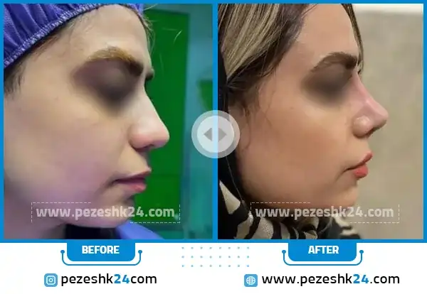 قبل و بعد از جراحی بینی گوشتی دکتر موسوی