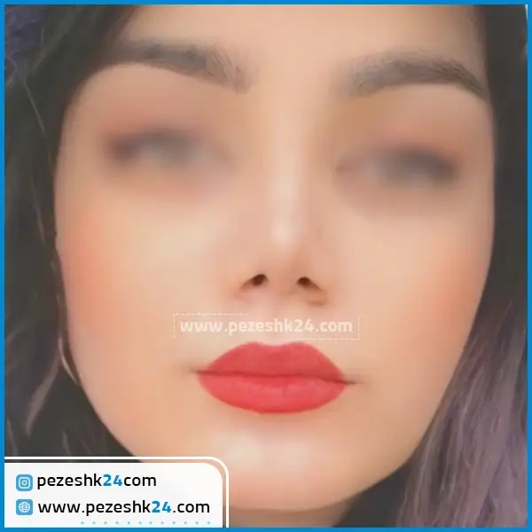 عمل بینی گوشتی دکتر موسوی مشهد