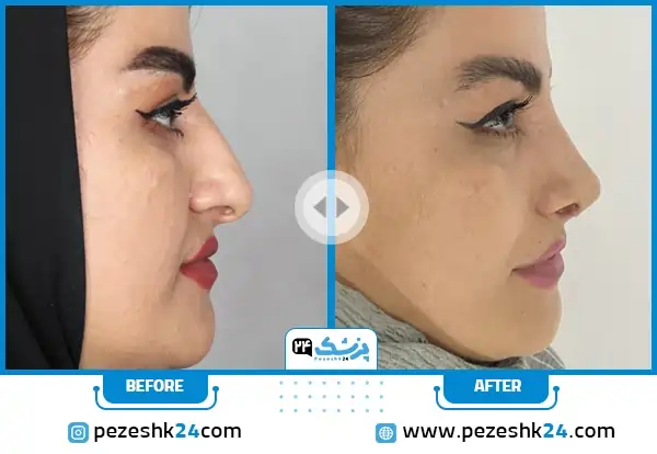 قبل و بعد عمل بینی دکتر مالکی مشهد