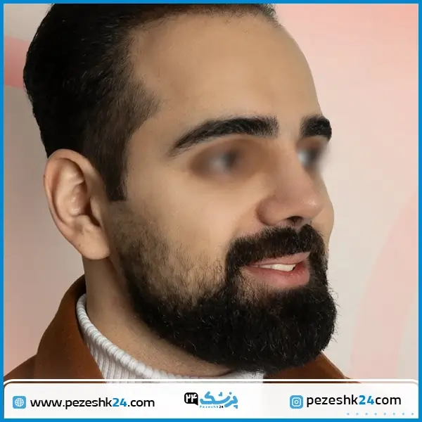 نمونه عمل بینی دکتر معتمدی فر مشهد