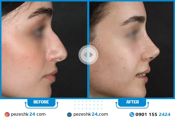 نمونه قبل و بعد جراحی بینی دکتر مسعود ناصری صدر