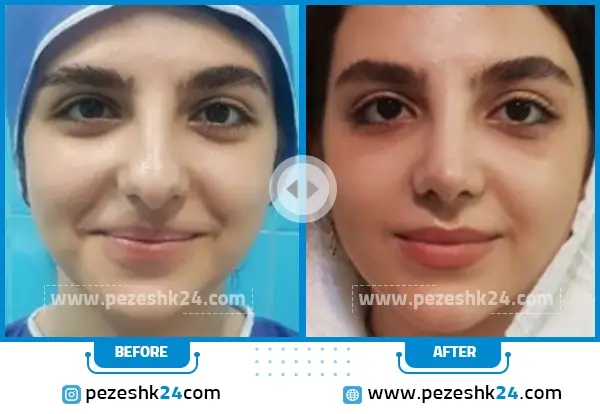 قبل و بعد از جراحی بینی دکتر پریسا نظر پور در مشهد