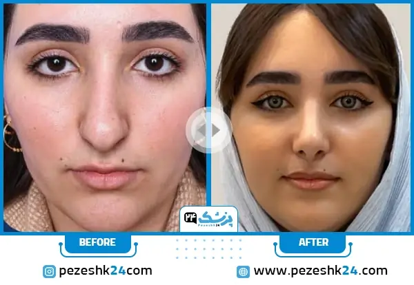 قبل و بعد عمل بینی دکتر رسولیان مشهد