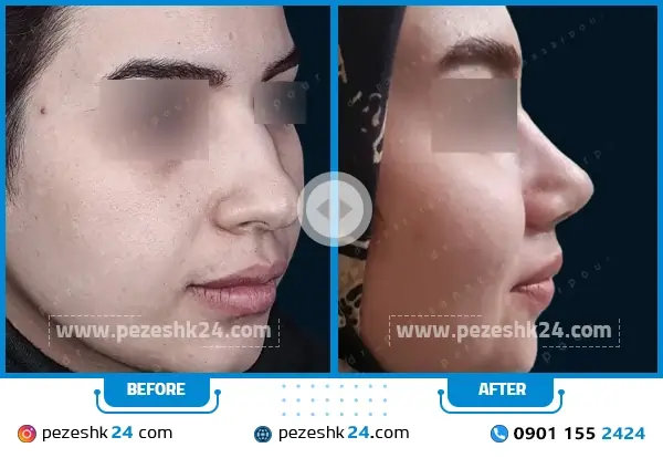 نمونه عمل بینی دکتر پریسا نظرپور مشهد