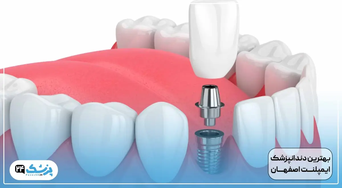 بهترین دکتر ایمپلنت در اصفهان
