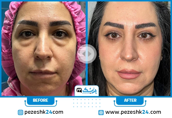 قبل و بعد جراحی بلفاروپلاستی دکتر کیوان رضایی