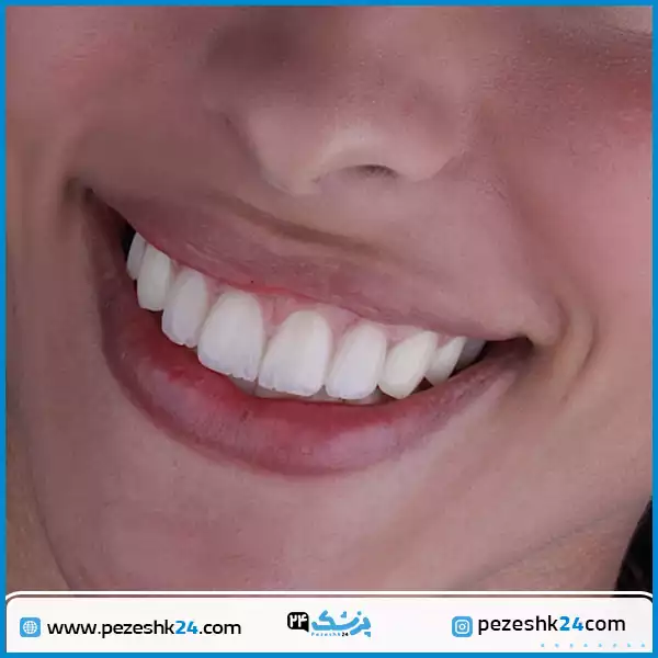 نمونه کامپوزیت دندان دکتر رمضانی تهران