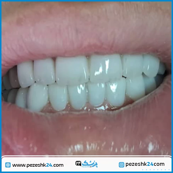 نمونه کامپوزیت دندان دکتر هاشمی مشهد