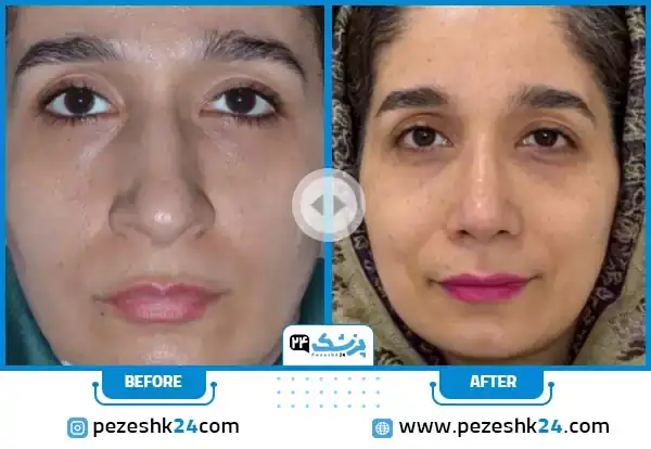 نمونه کار قبل و بعد عمل بینی بهترین دکتر عمل بینی در مشهد دکتر افسانه محمدپور مالکی