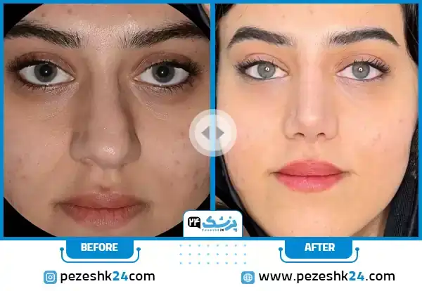 نمونه کار جراحی بینی دکتر افسانه محمدپور مالکی در مشهد