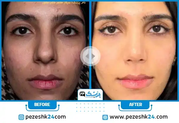 نمونه کار عمل بینی دکتر افسانه محمدپور مالکی در مشهد