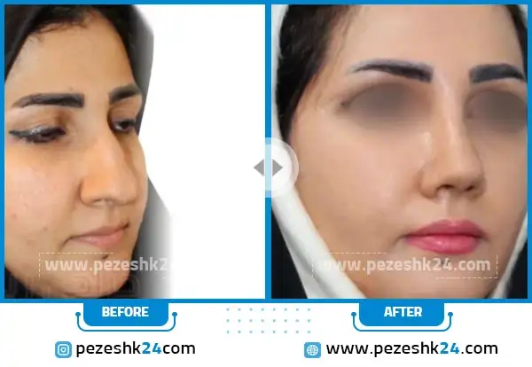 نمونه عمل زیبایی بینی دکتر فرزادفرد