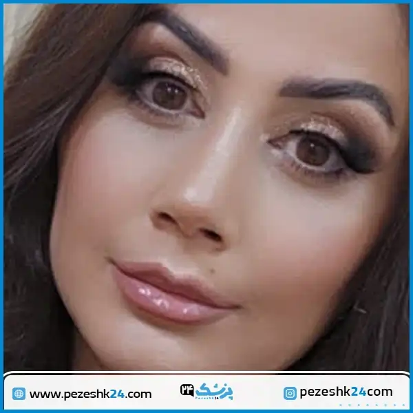 عکس نمونه عمل بینی طبیعی دکتر زرین قلم در مشهد