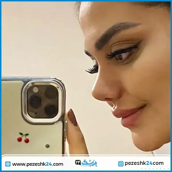 نمونه کار عمل بینی دکتر زرین قلم در مشهد
