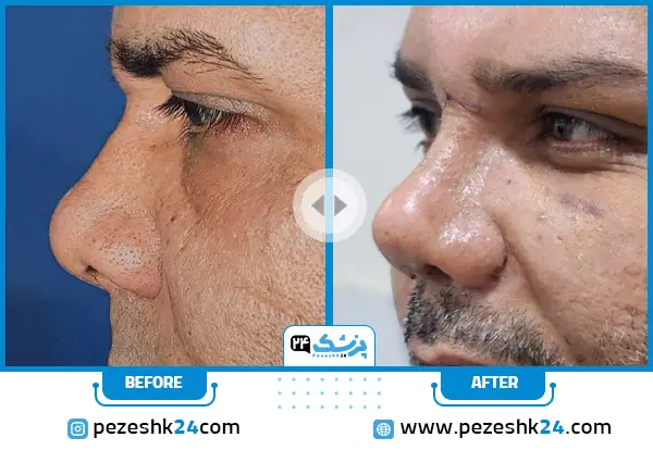 نمونه کار عمل بینی گوشتی مردانه دکتر صاحب حسینی نژاد در اهواز