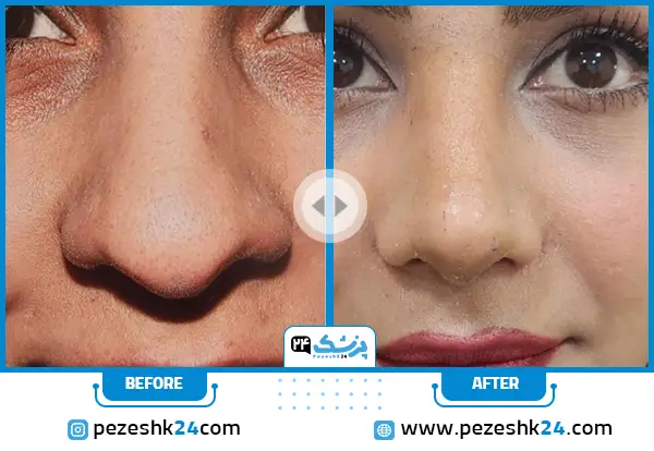 نمونه کار عمل بینی گوشتی با نوک افتاده دکتر صاحب حسینی نژاد در اهواز