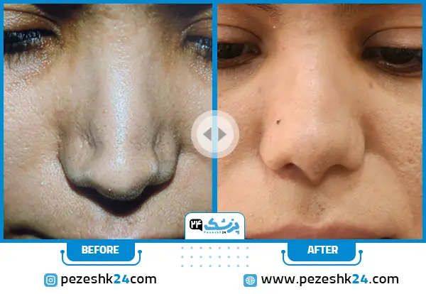 نمونه کار عمل بینی گوشتی ترمیمی دکتر صاحب حسینی نژاد در اهواز
