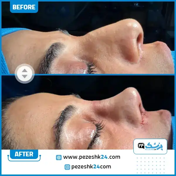 نمونه کار عمل بینی طبیعی دکتر وحیده موسوی در مشهد