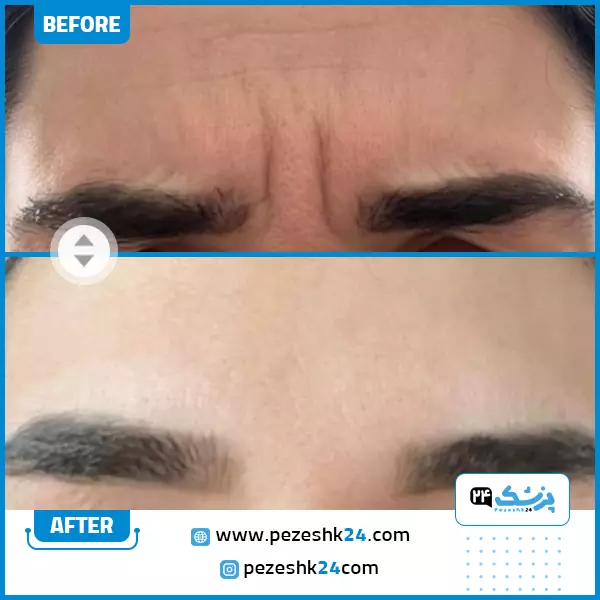 نمونه کار قبل و بعد بوتاکس در تهران توسط دکتر زهرا عبادی موحد