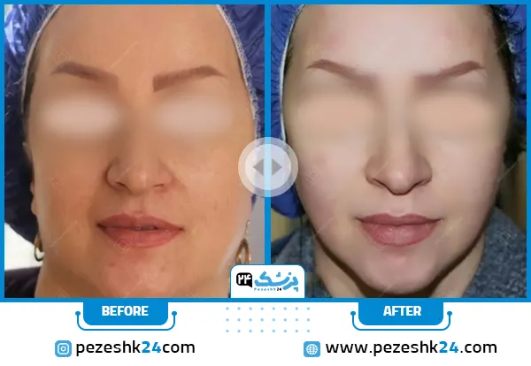 قبل و بعد هایفوتراپی صورت کلینیک دکتر نیلفروش زاده