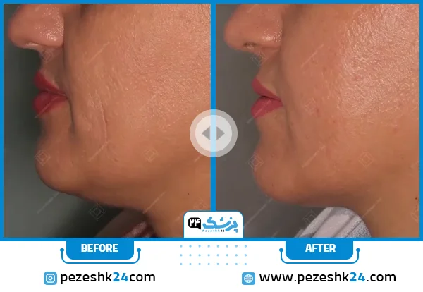 قبل و بعد هایفوتراپی کلینیک دکتر نیلفروش زاده
