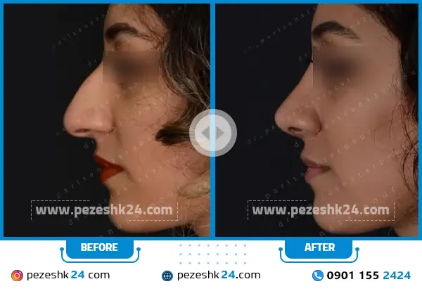 نمونه عمل دکتر پریسا نظر پور جراح بینی در مشهد