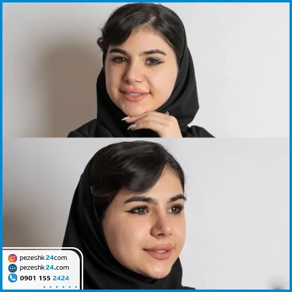 نمونه عمل دکتر نظر پور جراح بینی مشهد