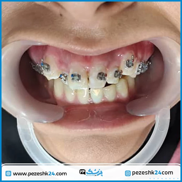 نمونه ارتودنسی دندان دکتر هاشمی مشهد