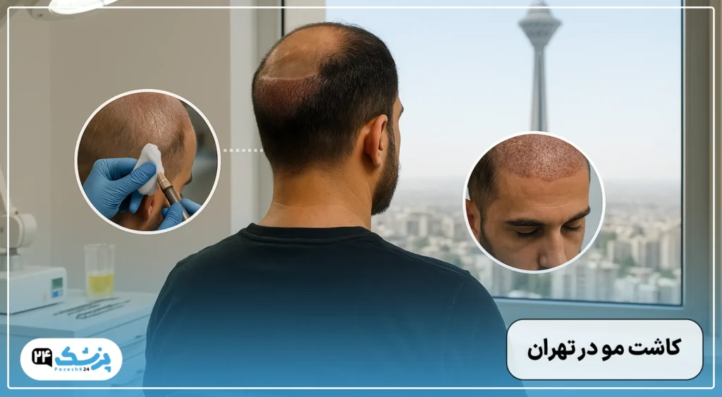 کاشت مو در تهران