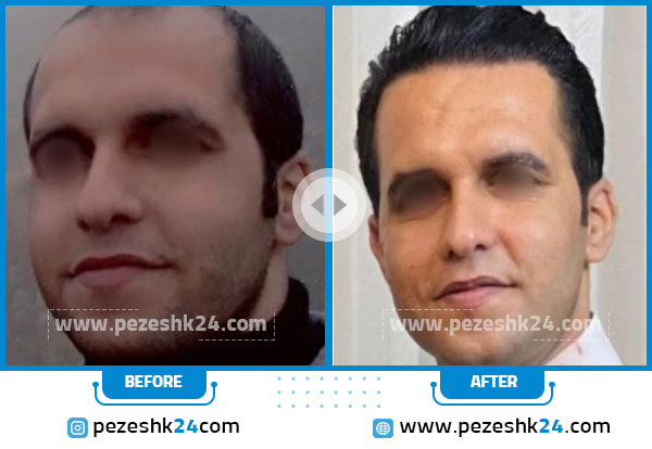 قبل و بعد کاشت مو کلینیک تندیس سلامت