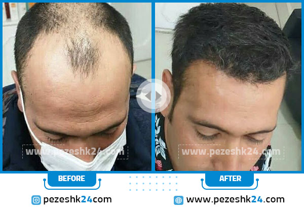نمونه قبل و بعد کاشت مو کلینیک تندیس سلامت مشهد