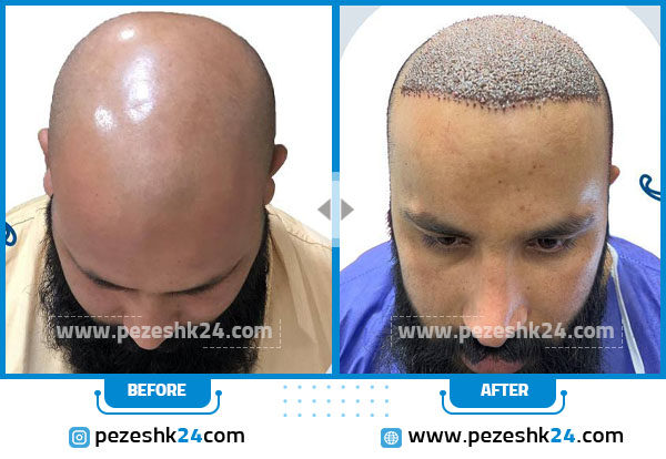 نمونه قبل و بعد از کاشت مو کلینیک تندیس سلامت