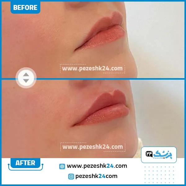 تزریق ژل لب نیم سی سی