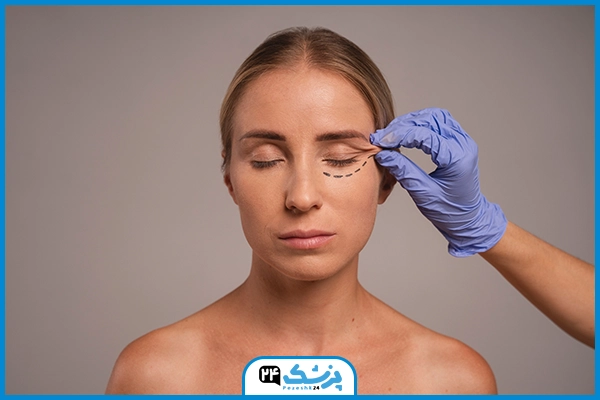 جایگزین بوتاکس چشم گربه ای