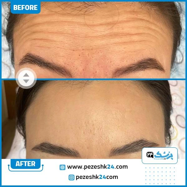 عکس قبل و بعد بوتاکس پیشانی