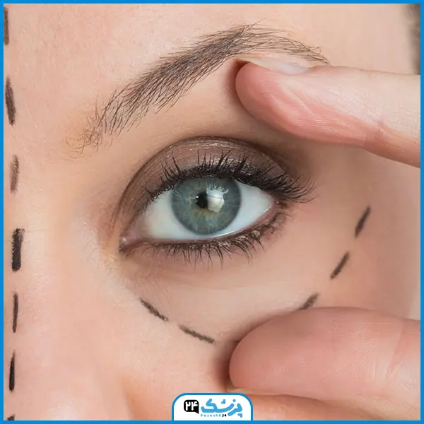 نمونه چشم گربه ای