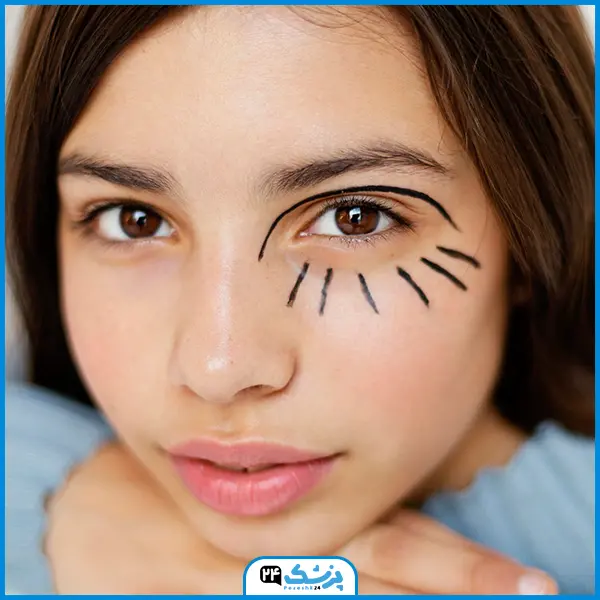 قیمت بوتاکس چشم گربه ای