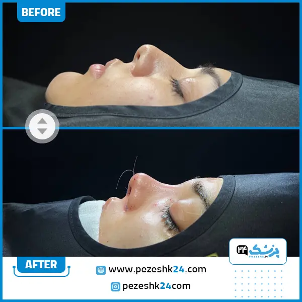 قبل و بعد عمل بینی فانتزی دکتر تیموری مشهد