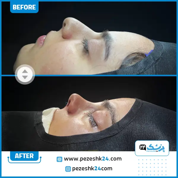 قبل و بعد عمل بینی عروسکی دکتر تیموری مشهد