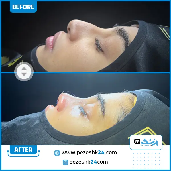 قبل و بعد عمل بینی عروسکی دکتر تیموری