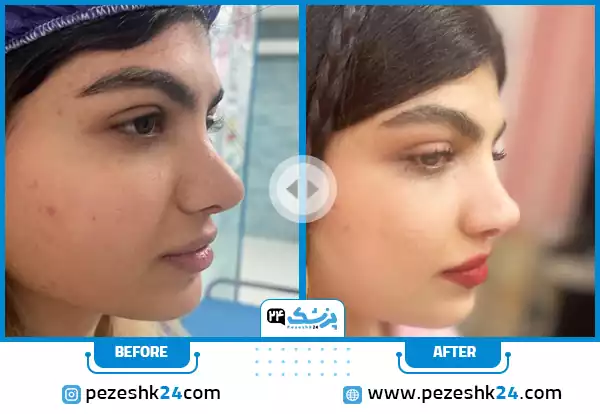 نمونه کار بینی گوشتی به سبک عمل بینی طبیعی دکتر وحید عین آبادی در شیراز