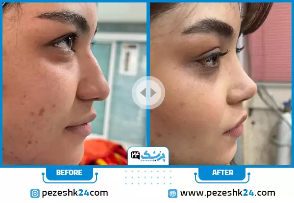 نمونه کار بینی استخوانی به سبک عمل بینی طبیعی دکتر وحید عین آبادی در شیراز