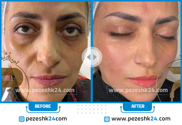 نمونه قبل و بعد هایفوتراپی خانم دکتر نادری مشهد