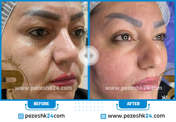 نمونه قبل و بعد هایفوتراپی خانم دکتر نادری