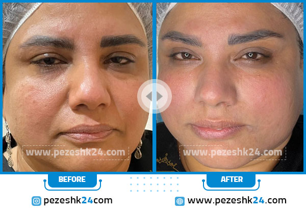 قبل و بعد هایفوتراپی خانم دکتر نادری مشهد