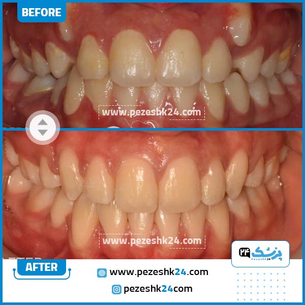 نمونه قبل و بعد ارتودنسی دندان دکتر دکتر محمدتقی وطن دوست