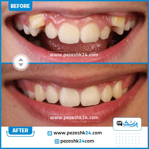 قبل و بعد ارتودنسی دکتر دکتر وطن دوست در تهران