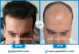 قبل و بعد کاشت مو کلینیک سینایار دکتر پارسانوایی در اصفهان