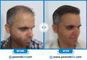 نمونه قبل و بعد کاشت مو در کلینیک سینایار