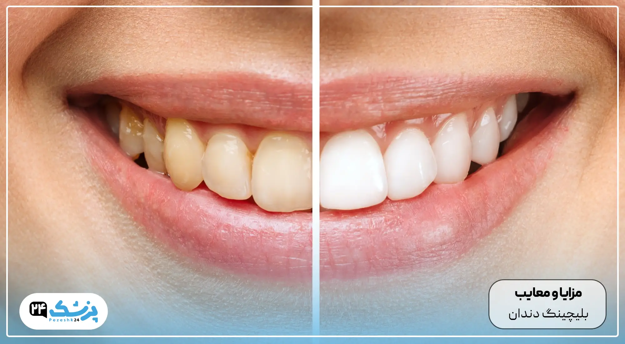 بلیچینگ دندان چقدر دوام دارد